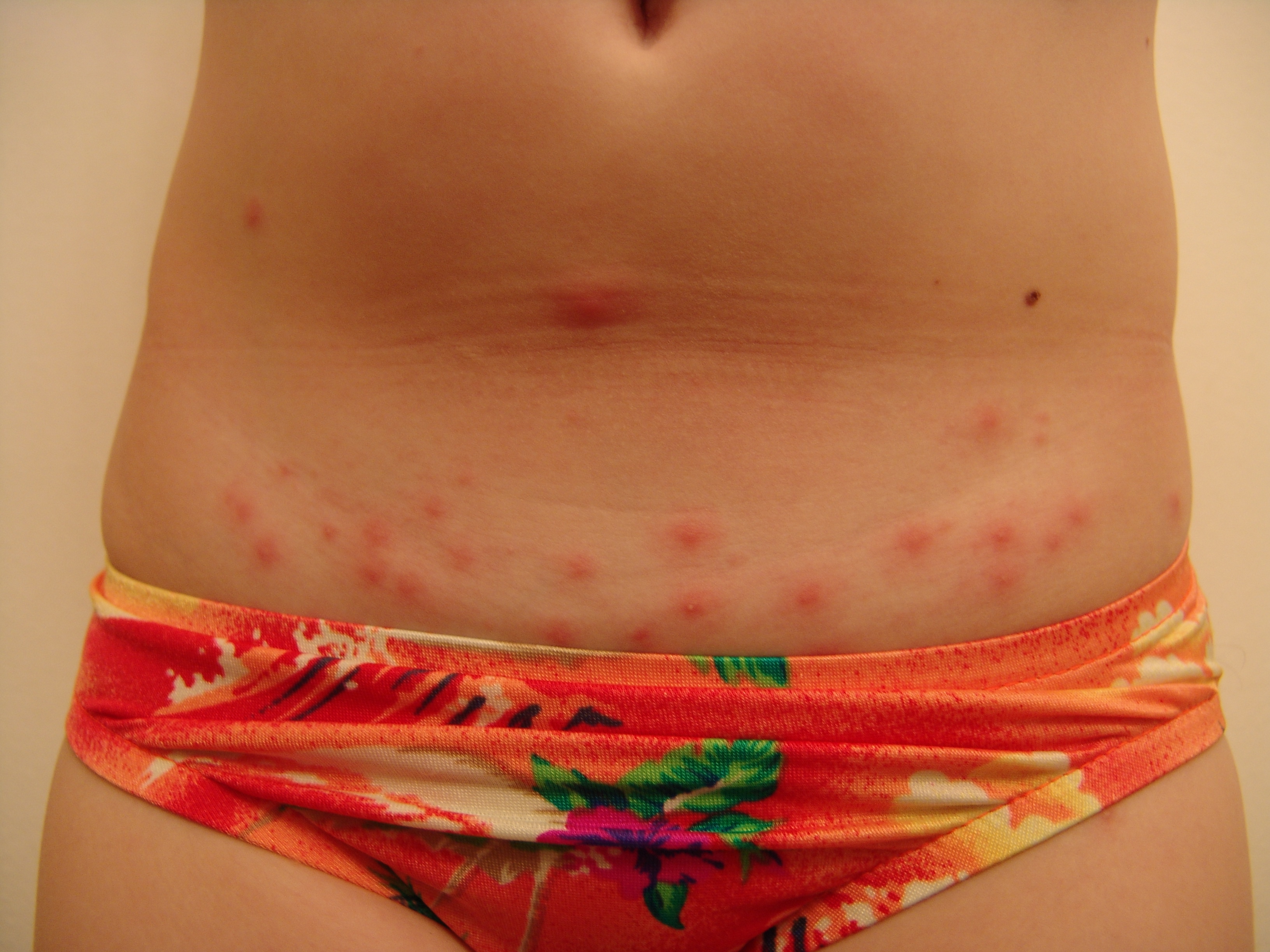 Young Girl With A Pruritic Rash